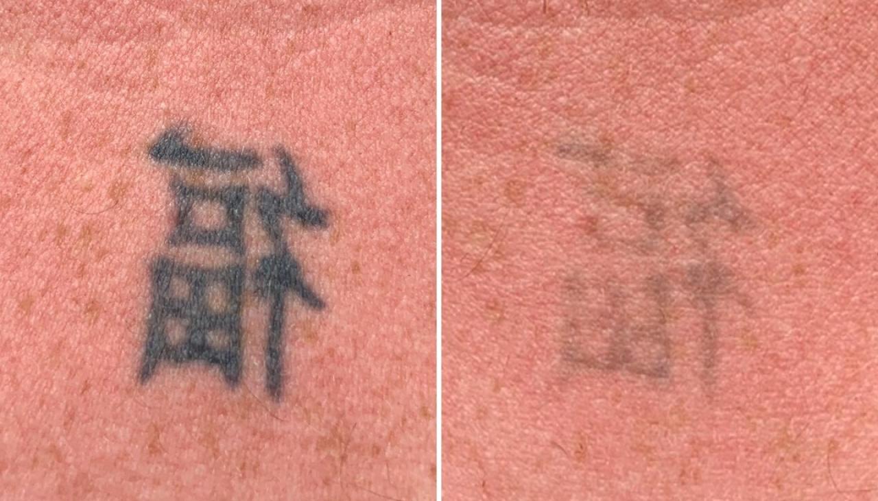 Tattoo removal before and after: What laser treatment is really like |  Newshub