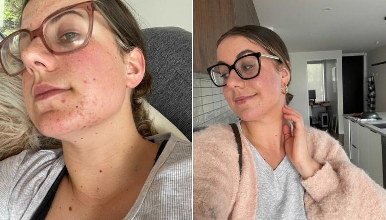 Opinion: Healing my inflamed, acne-ridden skin after coming off