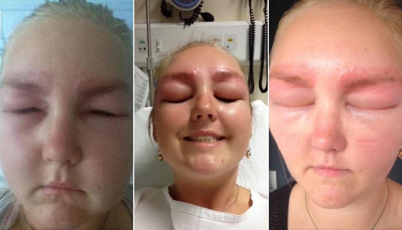 Australian bride left looking 'like an alien' after suffering allergic reaction to brow tint