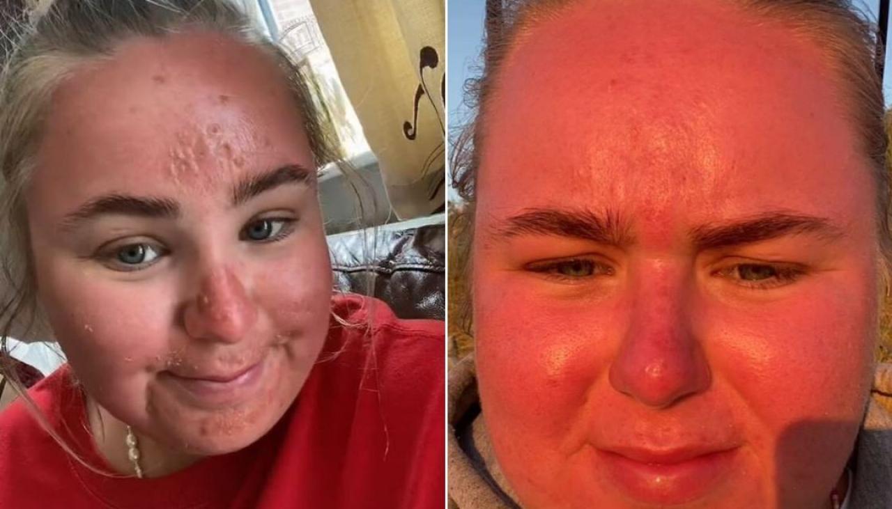 Ola de calor en Europa: una mujer comparte horribles quemaduras solares después de solo una hora en la playa en el Reino Unido