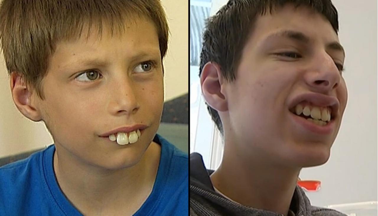 stressende kreativ Tilskud Bullied buck-toothed kid finally gets his perfect smile | Newshub