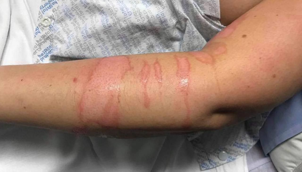 Nurse left with second-degree burns after patient attacks her with