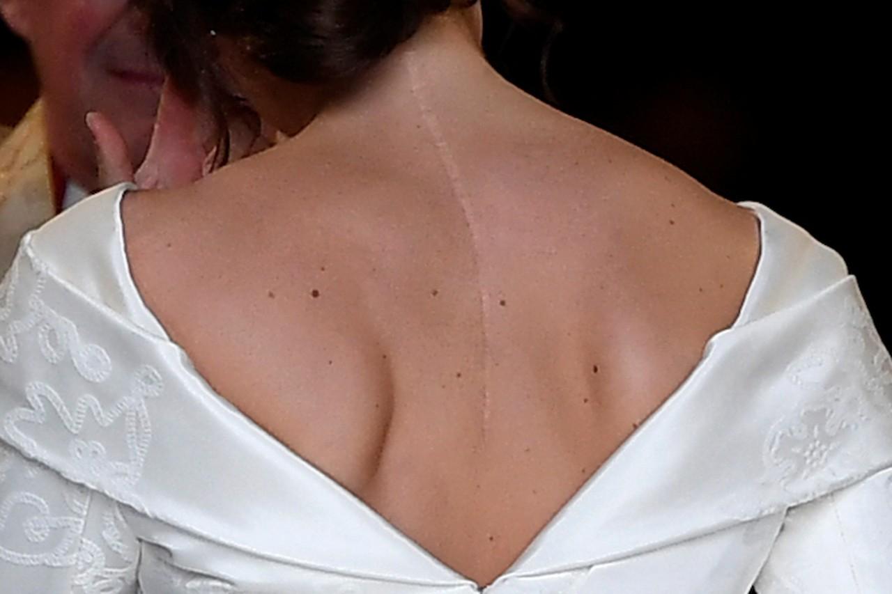 Image result for Princess Eugenie shows off scoliosis surgery scar on wedding day