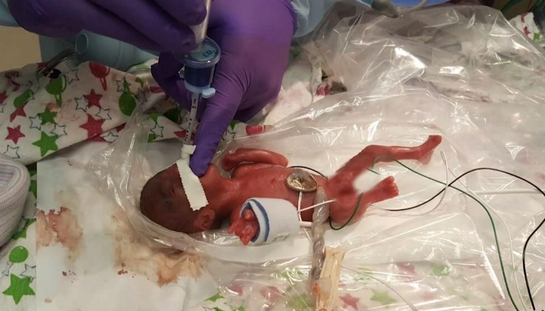 US baby born at 23 weeks becomes smallest baby to survive ...